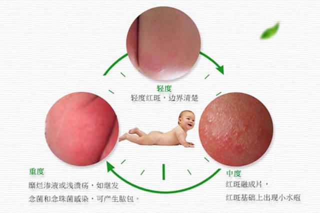 宝宝o型腿怎么回事
