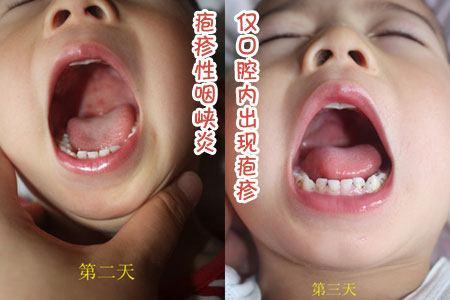 疱疹性咽峡炎能不能打疫苗