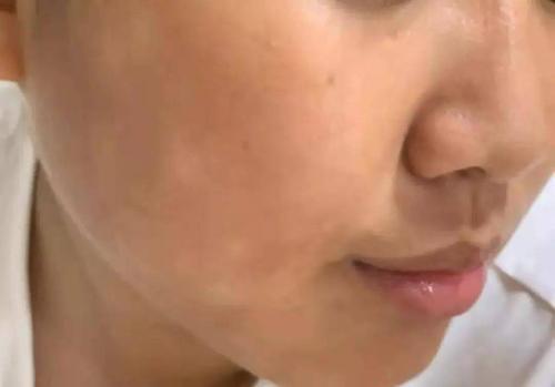 如何预防秋冬季皮肤瘙痒