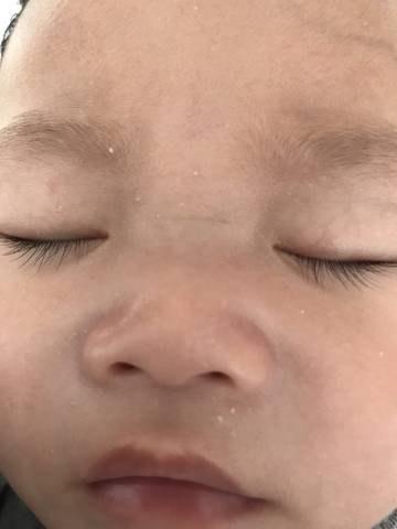 宝宝的脸上有一团团白色的东西是什么