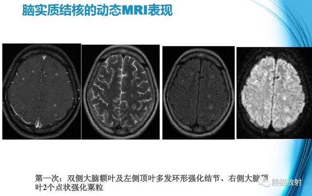 小儿脑膜炎是怎么引起的
