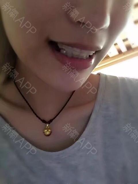 戴牙套要带多久保持器