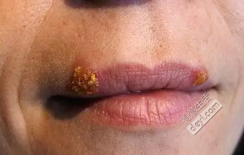 孩子是怎么感染上eb病毒的