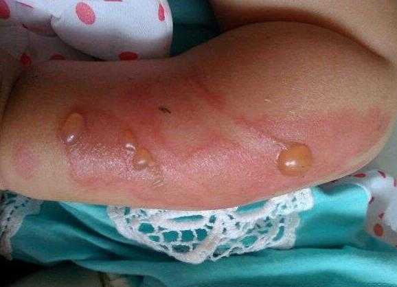 十一个月宝宝被烫伤怎么办