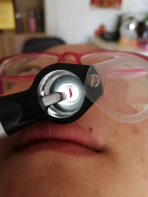 宝宝腺样体肥大怎么办