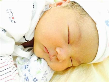 母乳性黄疸有哪些症状