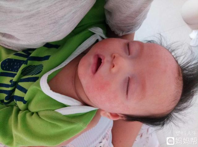 婴儿湿热湿疹怎么办