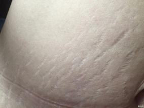乳房妊娠纹和橘皮纹的区别