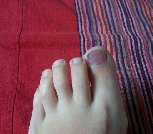 关于鸵鸟油按摩膏的散瘀效果实验不断更新中