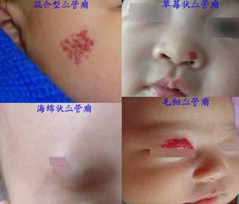 孩子总是被蚊虫咬怎么办