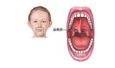 扁桃体切除后对儿童有什么影响