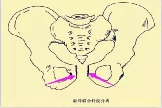 孕晚期小肚子痛是怎么回事，怎么办