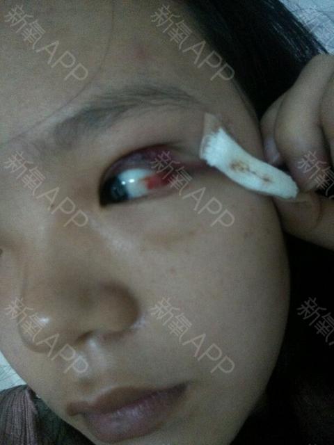 孩子长麦粒肿怎么办好