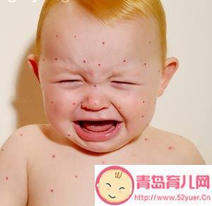 青春期的孩子起水痘怎么办