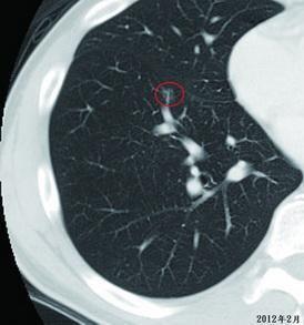 怎么分辨肺结节是良性还是恶性的