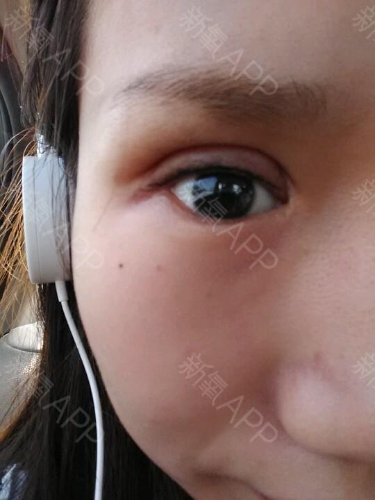 出去撒欢了,眼睛花了眼线,还有左右眼的图片右眼好的差不多了