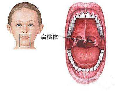 小孩经常扁桃体发炎是怎么回事