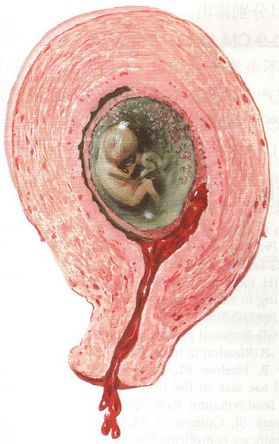 生化妊娠流产的图片图片