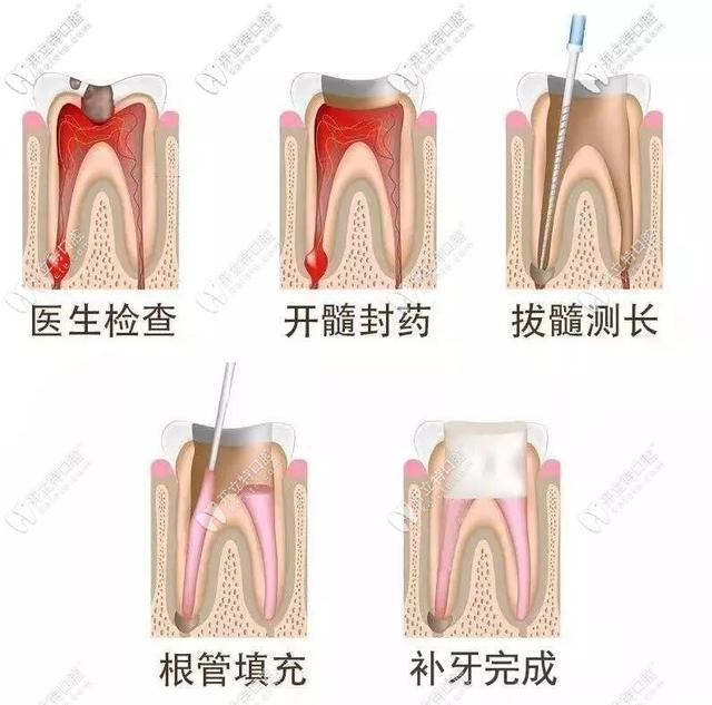 牙疼该怎么办立刻止疼