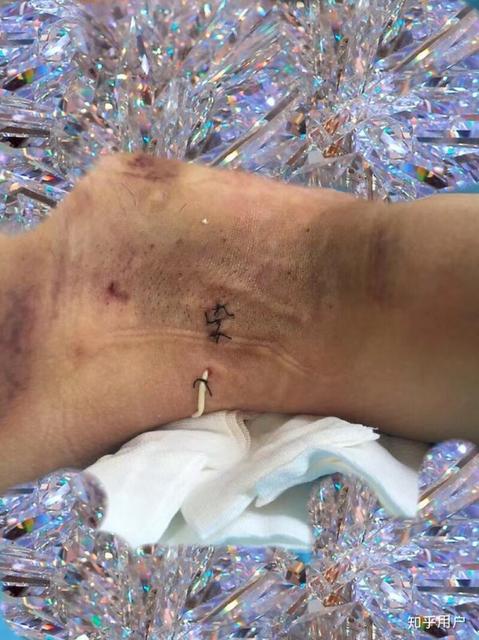 腋臭和狐臭有什么区别怎么辨别图片