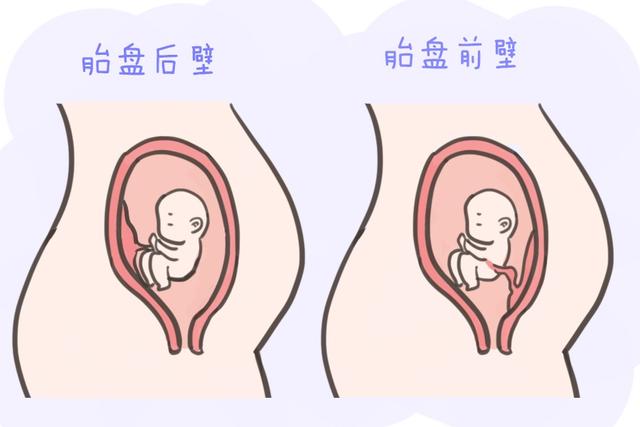 前置胎盘和胎盘位于前壁有什么区别