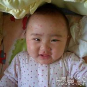 小孩得水痘初期症状是什么样子