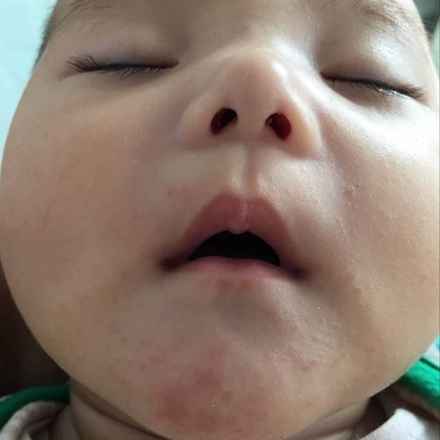 宝宝口水疹反复出现该怎么办