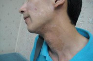 两大诱因让你知道白癜风为何发生