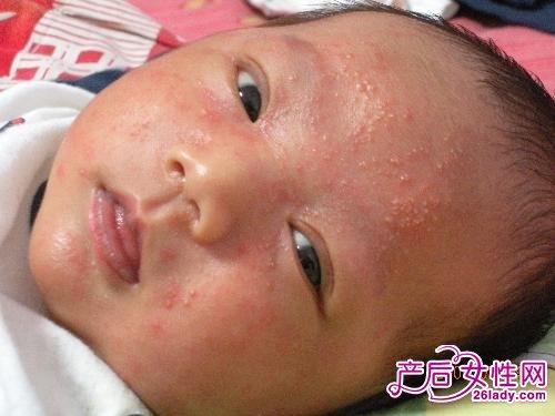 婴儿湿疹怎么办