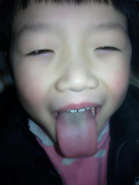 清鼻涕是黄颜色的是什么原因