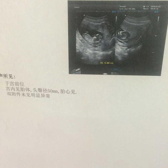 胖多囊促排第一次成功