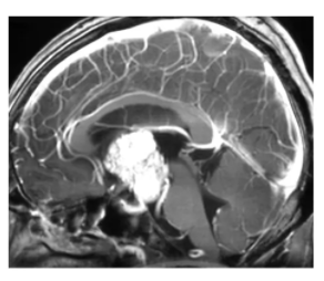 较常见的儿童肿瘤有哪些