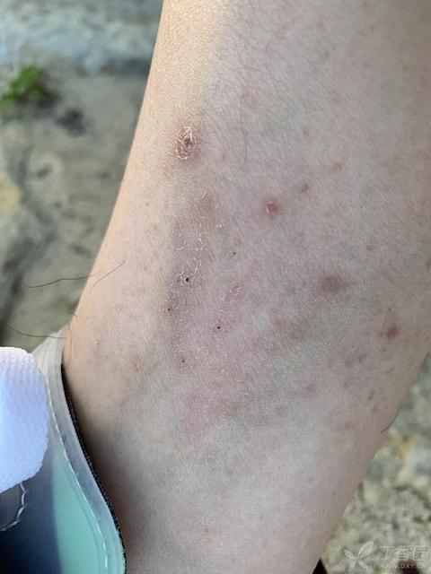 儿童湿疹会传染吗