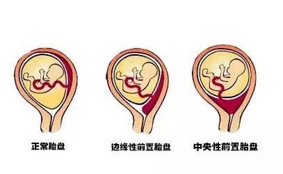 孕妇胎盘前置的原因