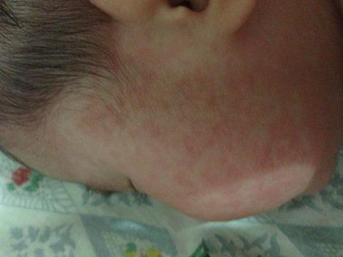 孩子感冒能用抗生素吗