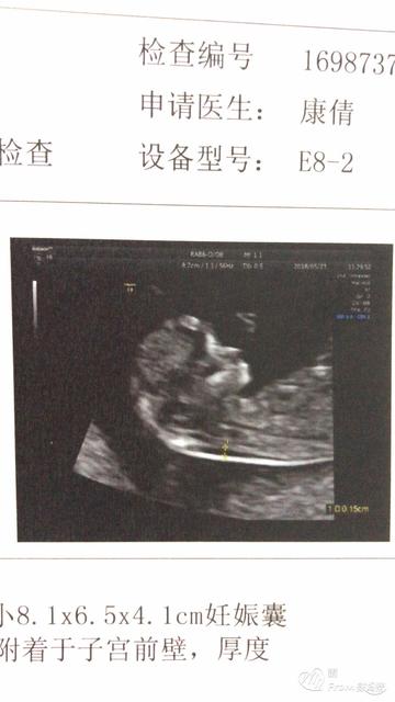 NT和唐筛免费筛查需要什么证件