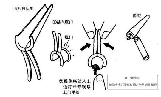 「痔疮检查」肛门镜检查痛苦吗?都查些啥?收藏备用!