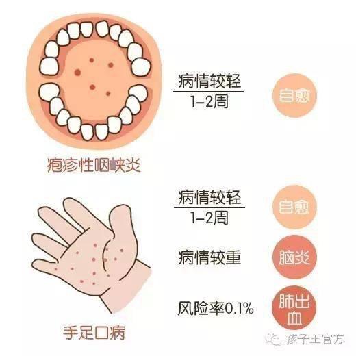 儿童疱疹性咽峡炎需要吃药吗