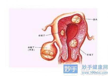 子宮肌瘤哪幾種情況需要手術切除