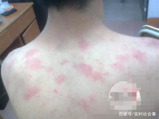 宝宝突然皮肤过敏应该怎么办