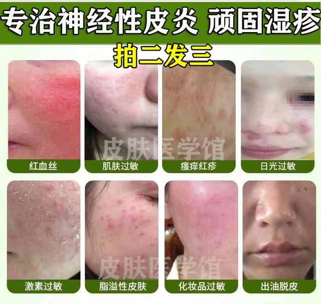 给孩子使用的外用激素药膏