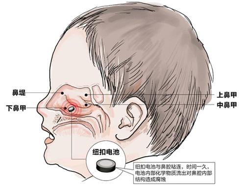 孩子爱往鼻子里塞东西怎么办