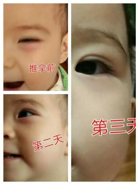宝宝呕吐后便秘怎么办