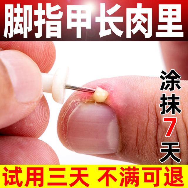 宝宝脚趾甲往肉里长怎么回事