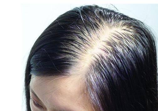真正的脱发儿童有哪些症状
