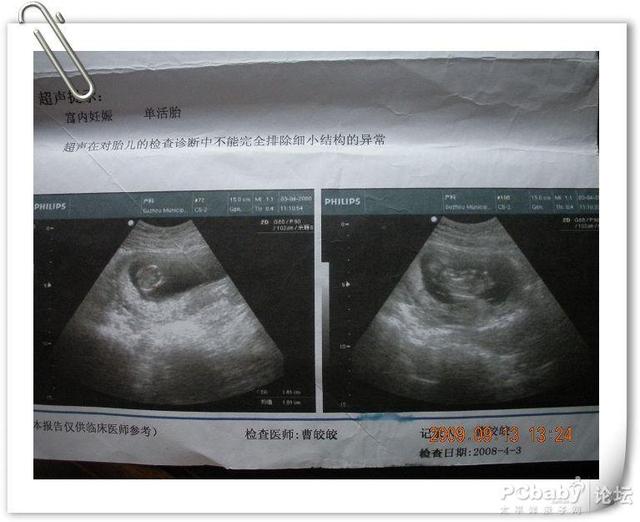 胎儿偏小一周是女孩吗?