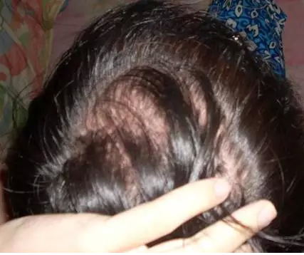 孕期皮肤爱出油怎么办？如何护理孕期油性肌肤