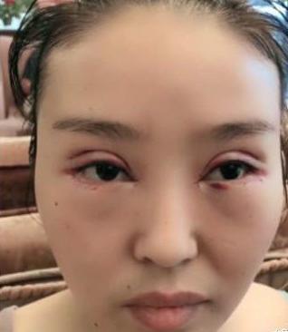 女子因鼻子太大被男友嘲笑猪鼻子,整容十几次后变身女神!
