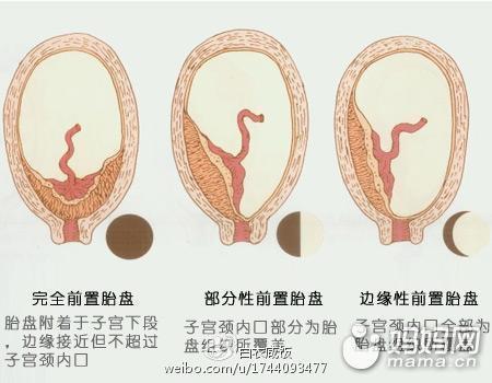 前置胎盘如何检查出来