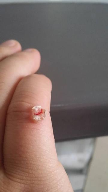 剪指甲不小心剪到肉